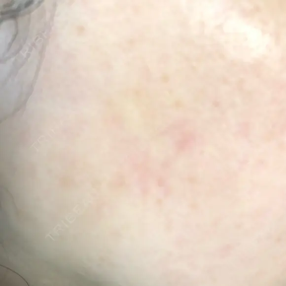 YAGレーザー 新宿美容外科クリニック 横浜院 AFTER メイン用