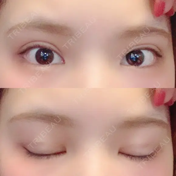 二重埋没 ビスポーククリニック 福岡院 DAY 49 メイン用