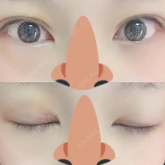 二重埋没 / 眼瞼下垂（切開） / その他（目元） 湘南美容クリニック 福島院 DAY 7 メイン用
