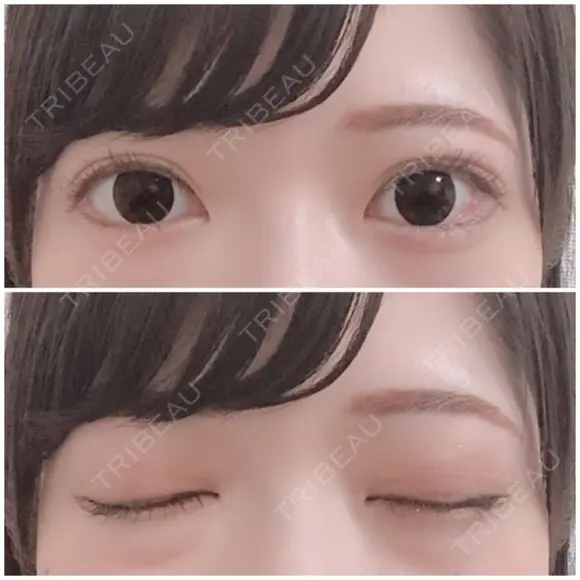 二重切開 / 上まぶたたるみ取り / 上まぶたの脂肪取り 銀座高須クリニック DAY 120 メイン用