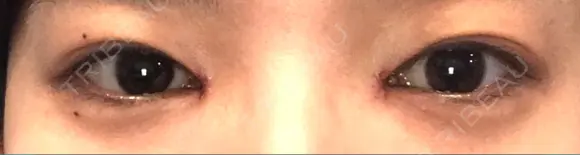 目頭切開 湘南美容クリニック 金沢院 AFTER メイン用