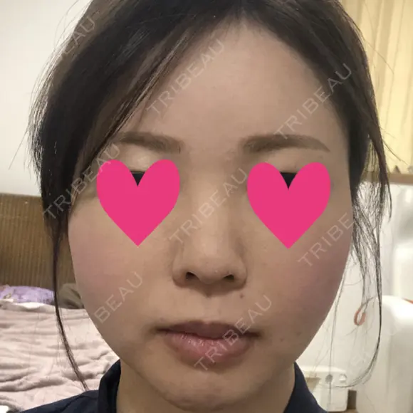 脂肪注入（輪郭） テラクリニック DAY 22 メイン用