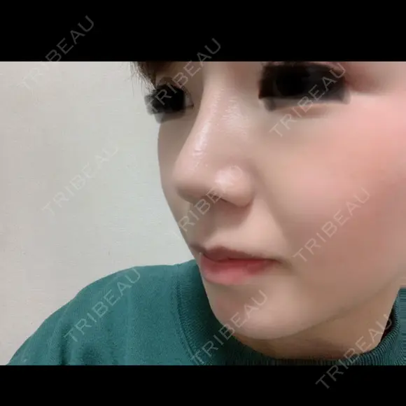 隆鼻術 / 鼻尖形成（切開） / 鼻中隔延長（切開） / 小鼻縮小（切開） / 鼻尖縮小 FROM B整形外科 (旧バウム整形外科) DAY 330 メイン用