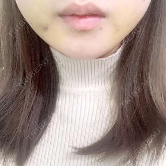 骨切り（あご） / 骨削り（エラ） ボンディ美容整形外科（旧リオン整形外科） DAY 7 メイン用