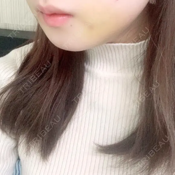 骨切り（あご） / 骨削り（エラ） ボンディ美容整形外科（旧リオン整形外科） DAY 7 メイン用