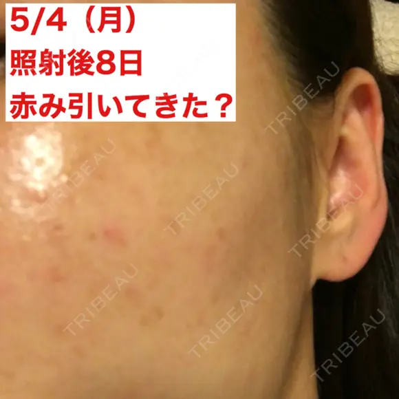 美肌レーザー / シミ取りレーザー / ピコレーザートーニング（美白・肝斑） 湘南美容クリニック 秋葉原院 DAY 8 メイン用