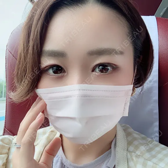 二重切開 / その他（目元） マーブル美容整形外科 DAY 6 メイン用
