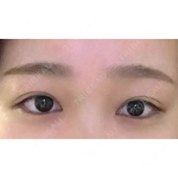 二重埋没 湘南美容クリニック 福島院 AFTER メイン用