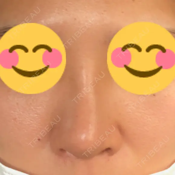 隆鼻術 たにまちクリニック DAY 7 メイン用