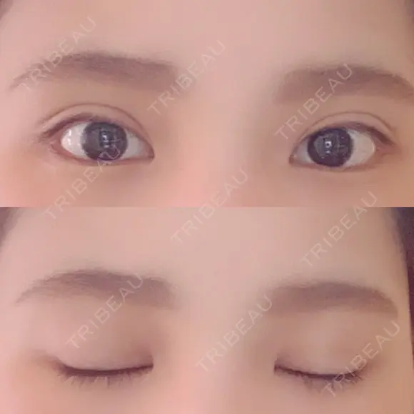 二重埋没 ビスポーククリニック 福岡院 DAY 59 メイン用