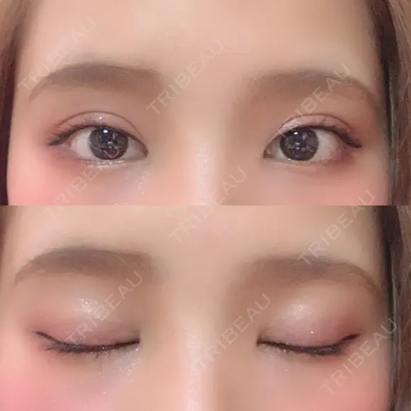 二重埋没 ビスポーククリニック 福岡院 DAY 59 メイン用