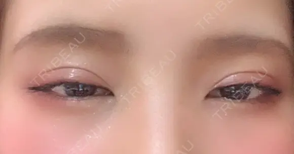 二重埋没 ビスポーククリニック 福岡院 DAY 59 メイン用