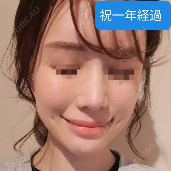 あごプロテーゼ / 骨削り（エラ） / 骨削り（頬） GNG美容外科 AFTER メイン用