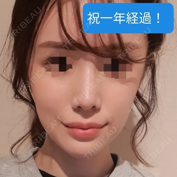 あごプロテーゼ / 骨削り（エラ） / 骨削り（頬） GNG美容外科 DAY 409 メイン用