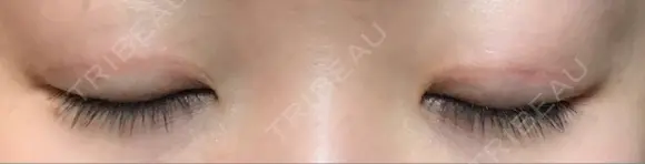 二重切開 / 上まぶたたるみ取り / 上まぶたの脂肪取り / 目元修正 リビジョンクリニック（旧：池本形成外科・美容外科） AFTER メイン用