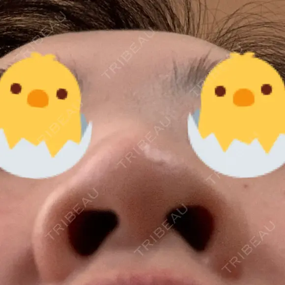 鼻尖形成（切開） / 鼻尖縮小 / ヒアルロン酸注入（鼻） 東京ヒルズクリニック 新宿院 DAY 162 メイン用