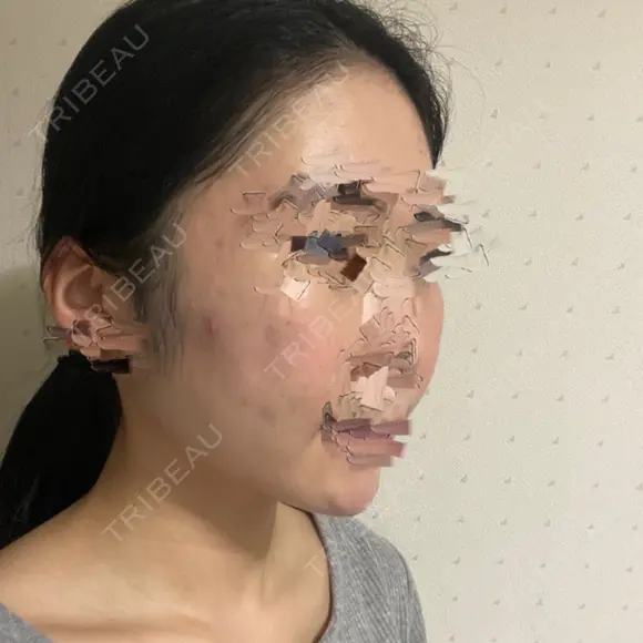 骨削り（頬） ボンディ美容整形外科（旧リオン整形外科） DAY 90 メイン用