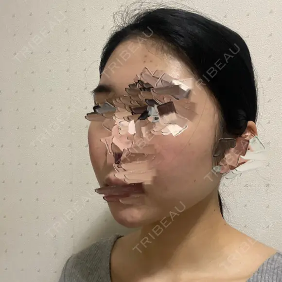 骨削り（頬） ボンディ美容整形外科（旧リオン整形外科） DAY 90 メイン用