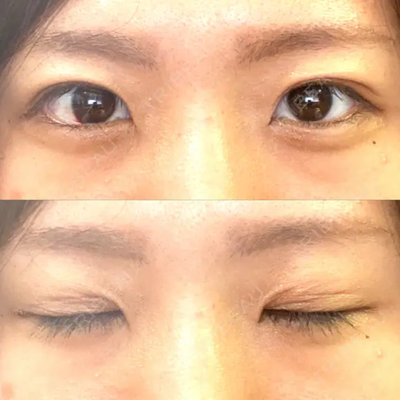 二重埋没 湘南美容クリニック 松山院 AFTER メイン用