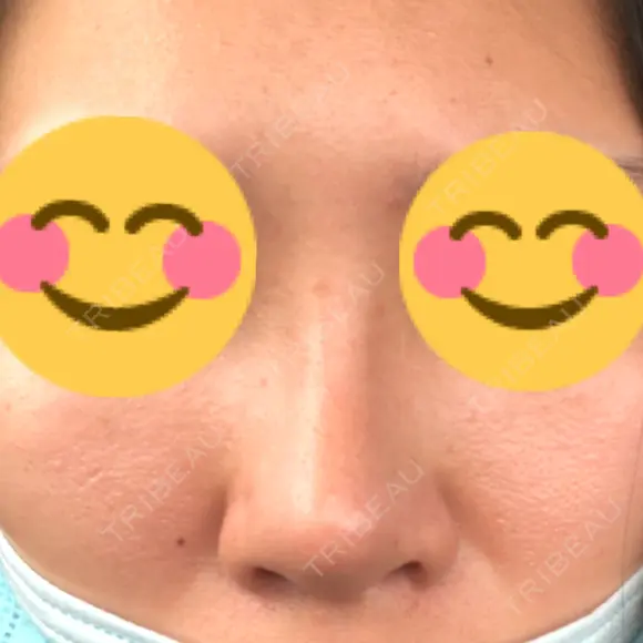 隆鼻術 たにまちクリニック DAY 9 メイン用