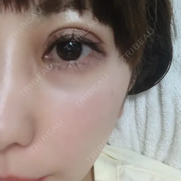 二重埋没 品川スキンクリニック沖縄院 DAY 10 メイン用