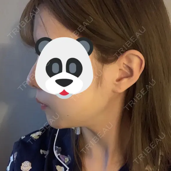 骨切り（あご） / 骨削り（エラ） ボンディ美容整形外科（旧リオン整形外科） DAY 31 メイン用