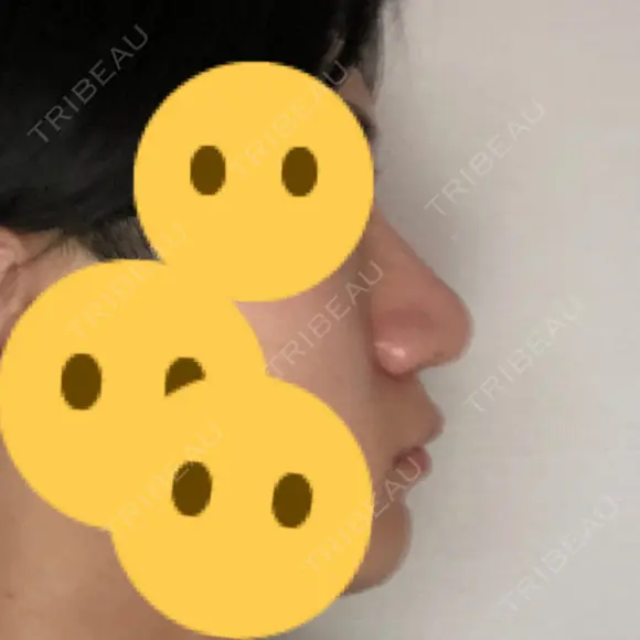 隆鼻術 / 鼻尖形成（切開） / 鼻中隔延長（切開） / 小鼻縮小（切開） / 軟骨移植 / 鼻孔縁挙上 / 鼻尖縮小 Zetith Beauty Clinic 銀座院 DAY 109 メイン用