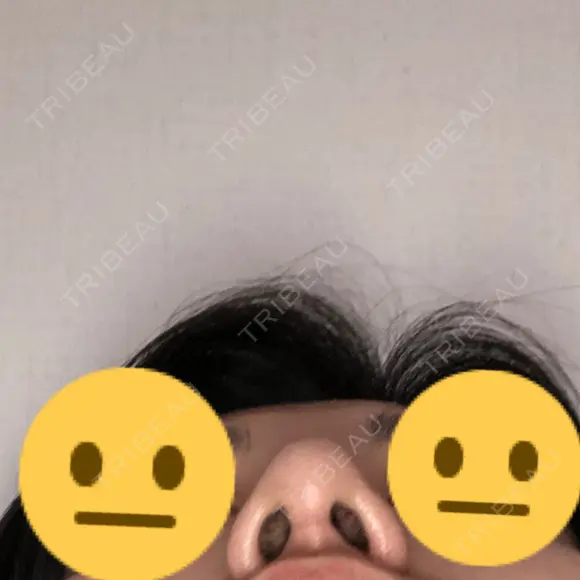 隆鼻術 / 鼻尖形成（切開） / 鼻中隔延長（切開） / 小鼻縮小（切開） / 軟骨移植 / 鼻孔縁挙上 / 鼻尖縮小 Zetith Beauty Clinic 銀座院 DAY 109 メイン用