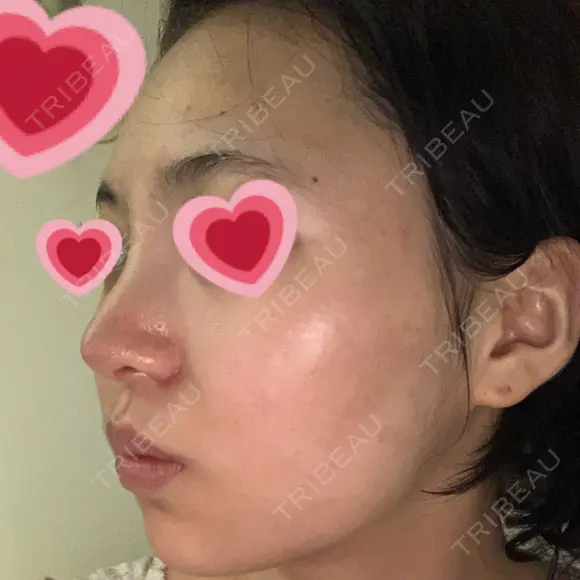隆鼻術 / 鼻尖形成（切開） / 小鼻縮小（切開） / 軟骨移植 / プロテーゼ除去 / 鼻修正 グローバルビューティークリニック 大阪院 DAY 19 メイン用