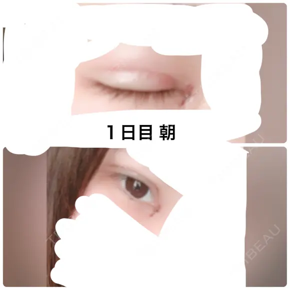 二重埋没 / 目頭切開 かめい美容クリニック宇都宮 DAY 1 メイン用