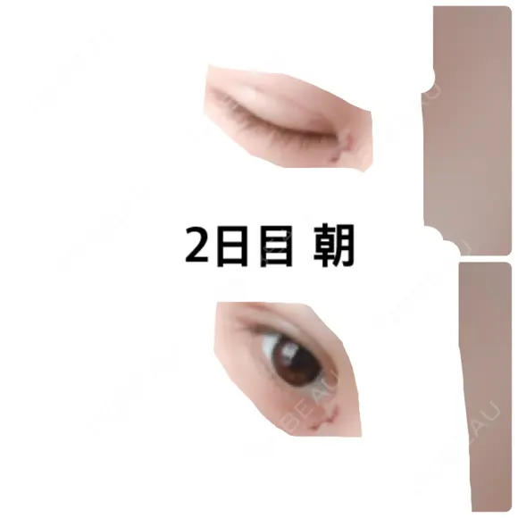 二重埋没 / 目頭切開 かめい美容クリニック宇都宮 DAY 2 メイン用