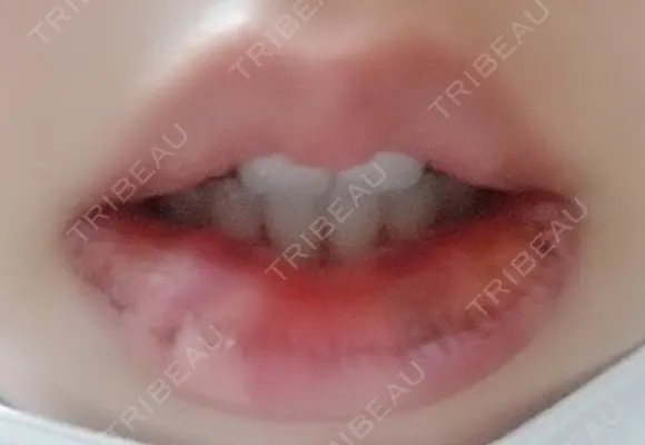 口唇縮小術 B-LINE CLINIC 池袋院 DAY 2 メイン用