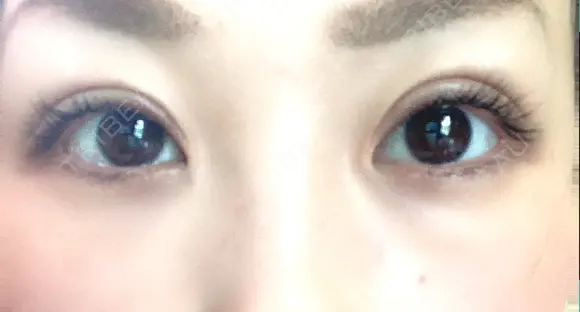二重切開 / 目頭切開 ばん皮膚科 DAY 146 メイン用