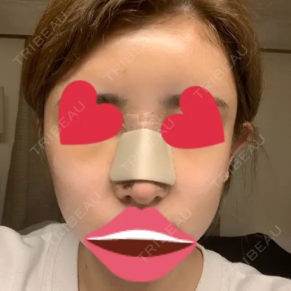 鼻尖形成（切開） / 鼻中隔延長（切開） / バッカルファット除去 / 軟骨移植 / 脂肪注入（額） / 鼻翼基部形成（貴族手術） Zetith Beauty Clinic 銀座院 DAY 3 メイン用