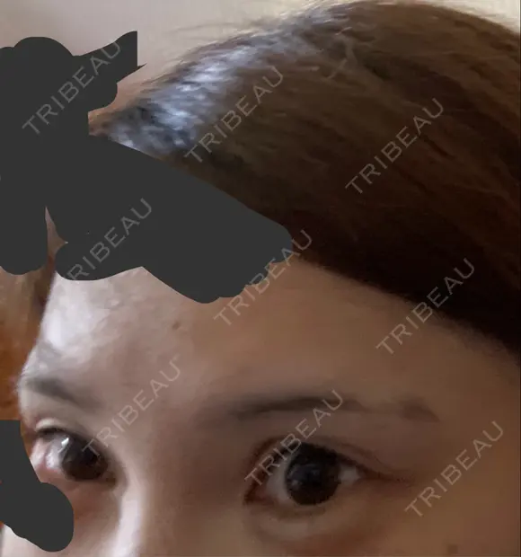 二重切開 牧野皮膚科形成外科内科医院 美容外科・形成外科・抗加齢医学外来 DAY 539 メイン用