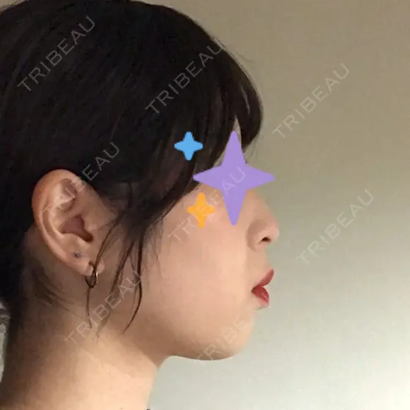 脂肪溶解注射（顔） 赤坂プレミアクリニック AFTER メイン用