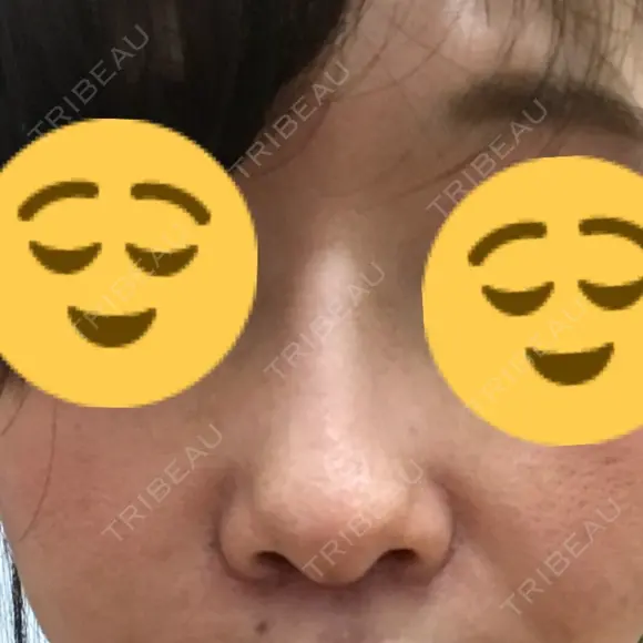 小鼻縮小（切開） / その他（鼻） 湘南メディカル記念病院（両国） DAY 8 メイン用