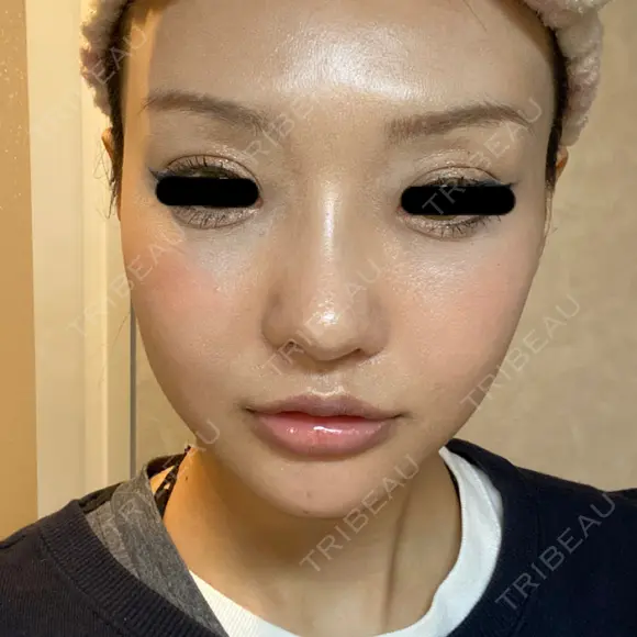 骨削り（エラ） / 骨削り（頬） / その他（輪郭） バノバギ整形外科 DAY 21 メイン用