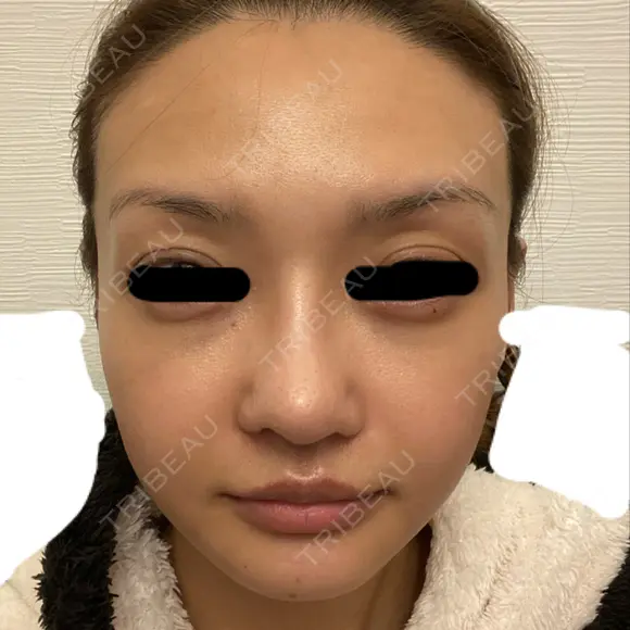 骨削り（エラ） / 骨削り（頬） / その他（輪郭） バノバギ整形外科 DAY 31 メイン用
