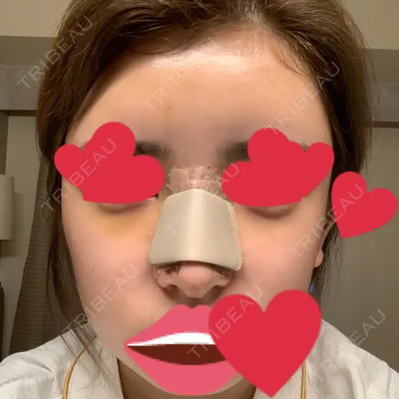 鼻尖形成（切開） / 鼻中隔延長（切開） / バッカルファット除去 / 軟骨移植 / 脂肪注入（額） / 鼻翼基部形成（貴族手術） Zetith Beauty Clinic 銀座院 DAY 4 メイン用