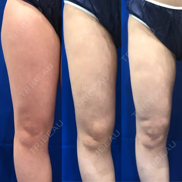 脂肪吸引（脚） / 豊胸（脂肪注入） 水の森美容クリニック 東京新宿院 DAY 90 メイン用