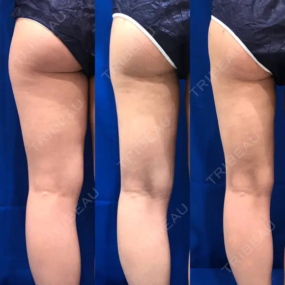 脂肪吸引（脚） / 豊胸（脂肪注入） 水の森美容クリニック 東京新宿院 DAY 90 メイン用