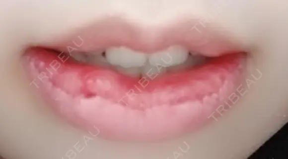 口唇縮小術 B-LINE CLINIC 池袋院 DAY 5 メイン用