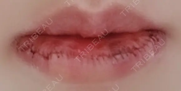 口唇縮小術 B-LINE CLINIC 池袋院 DAY 3 メイン用