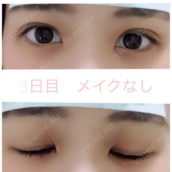 二重埋没 湘南美容クリニック 赤坂見附院 DAY 3 メイン用