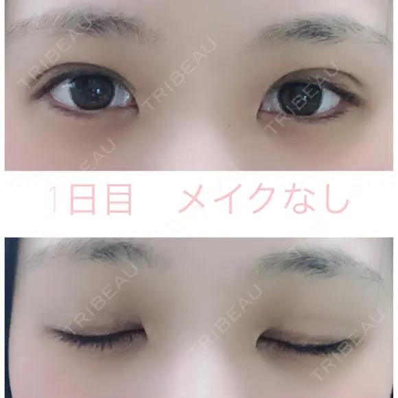 二重埋没 湘南美容クリニック 赤坂見附院 DAY 1 メイン用