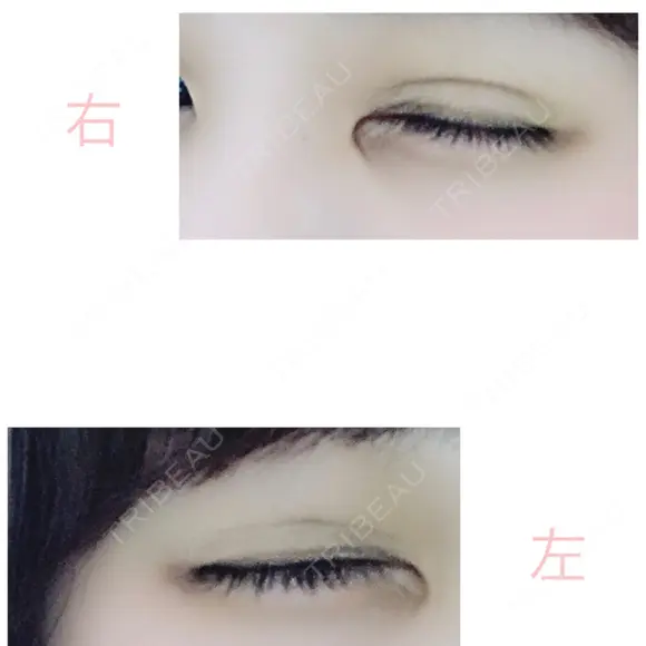 二重埋没 湘南美容クリニック 赤坂見附院 DAY 4 メイン用