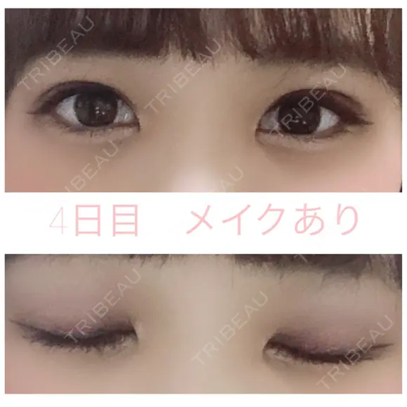 二重埋没 湘南美容クリニック 赤坂見附院 DAY 4 メイン用