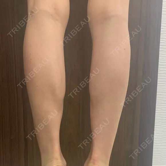 ボトックス（ふくらはぎ） TCB東京中央美容外科 中野院 DAY 0 メイン用