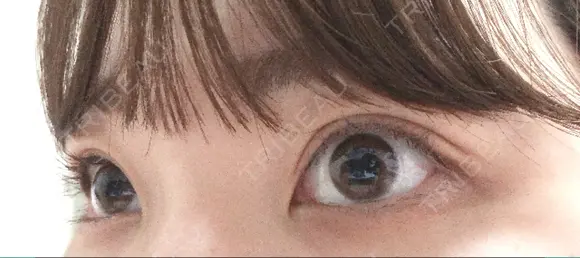 二重埋没 / 上まぶたの脂肪取り TCB東京中央美容外科 江坂院 AFTER メイン用